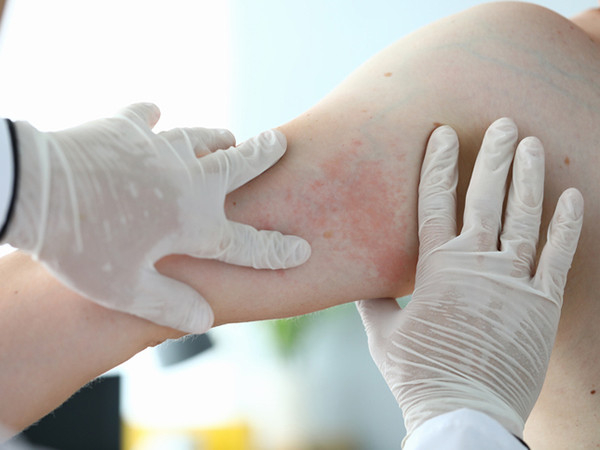 close-up photo of doctor examining a rash on a person's leg, gloved hands on either side of the affected area